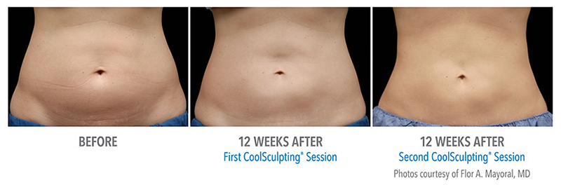 CoolSculpting - Cosmetic - Ark-La-Tex Dermatology - A Part of the Willis  Knighton Physician Network
