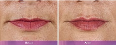 Juvederm Volbella