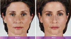 Juvederm Volbella