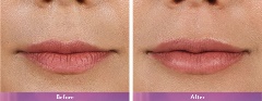 Juvederm Volbella