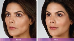 Juvederm Volbella