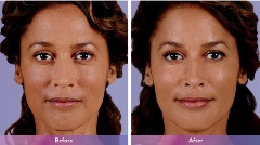 Juvederm