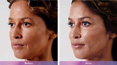 Juvederm