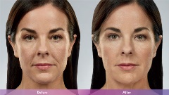 Juvederm