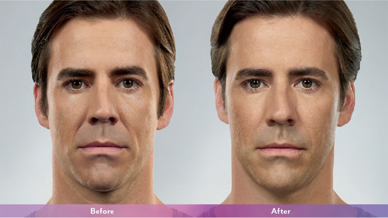 Juvederm