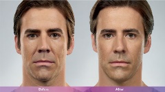 Juvederm